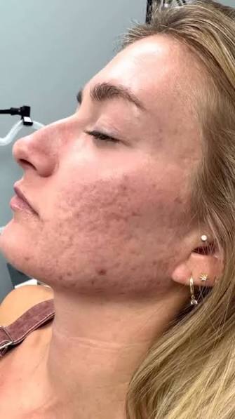 Macchie Post-Acne